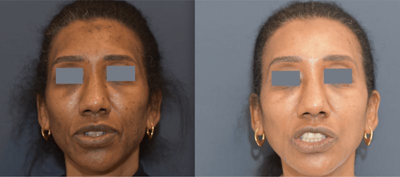 Chemical Peels Before & After Gallery - Patient 363513 - Image 1