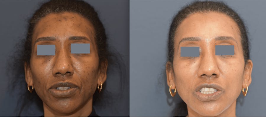 Chemical Peels Before & After Gallery - Patient 363513 - Image 1