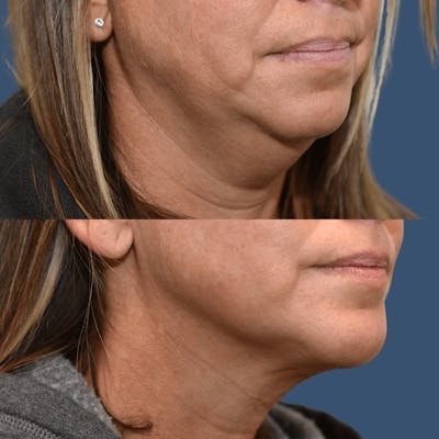 Facial Implants Before & After Gallery - Patient 674879 - Image 1