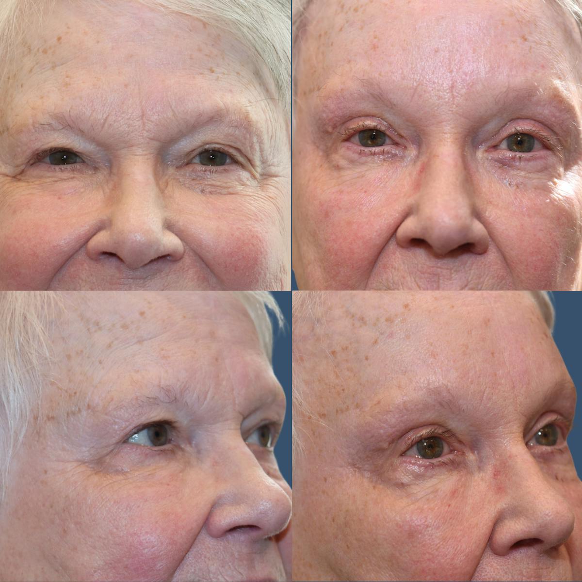 Upper Blepharoplasty Before & After Gallery - Patient 336733 - Image 1