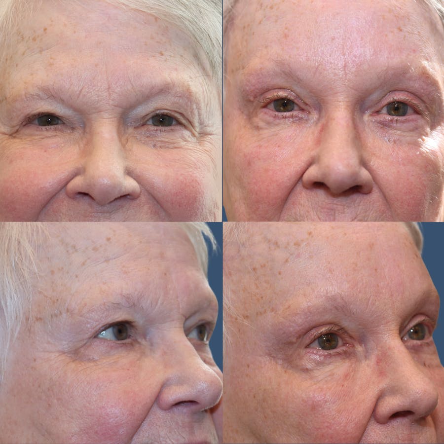Upper Blepharoplasty Before & After Gallery - Patient 336733 - Image 1