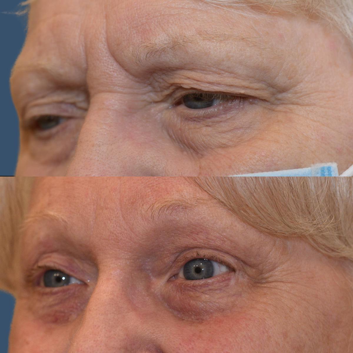 Upper Blepharoplasty Before & After Gallery - Patient 627667 - Image 2