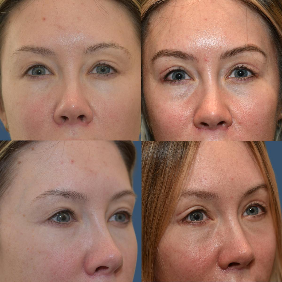 Endoscopic Brow Lift Before & After Gallery - Patient 272778 - Image 1
