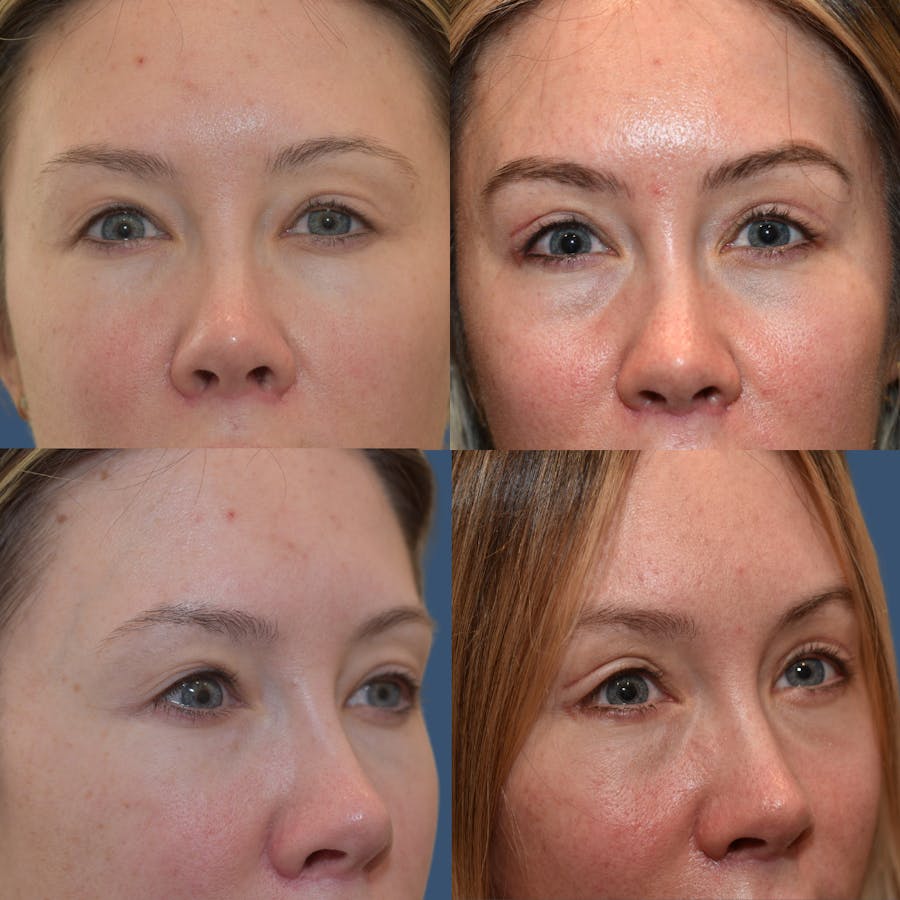 Endoscopic Brow Lift Before & After Gallery - Patient 272778 - Image 1