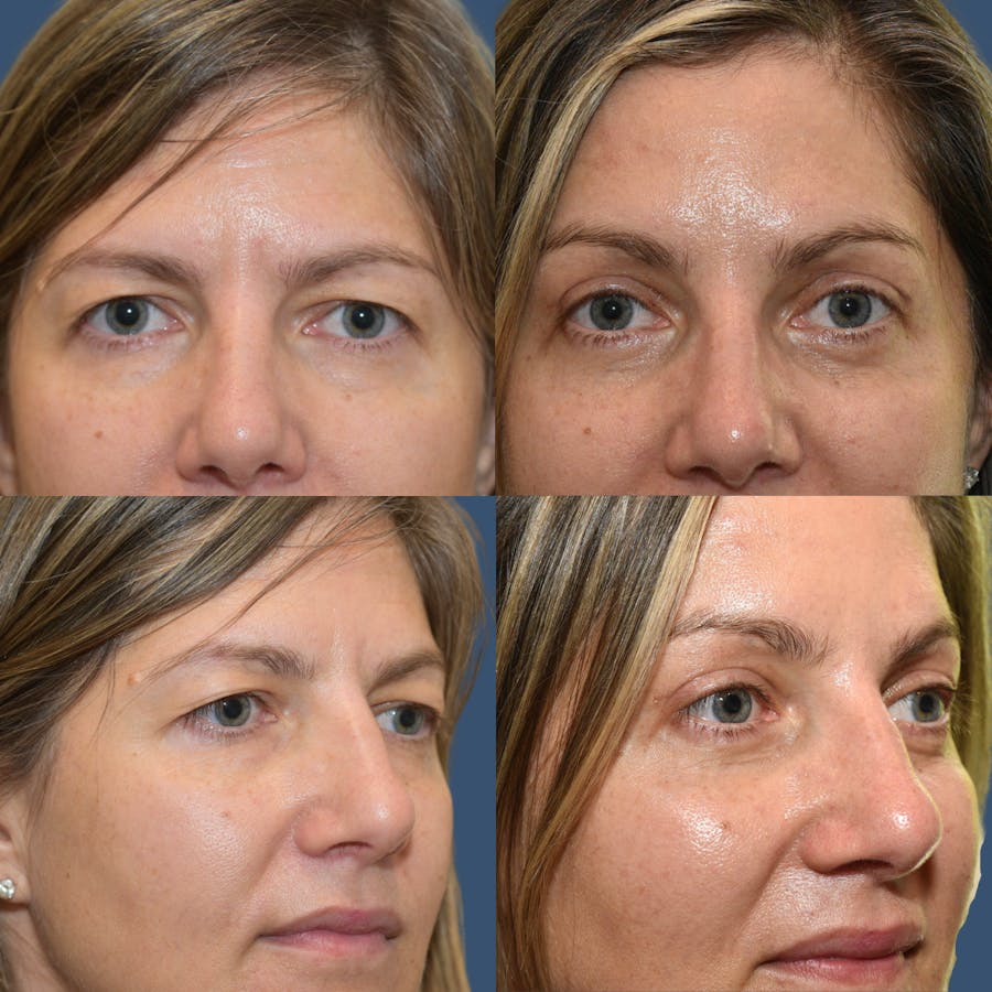 Endoscopic Brow Lift Before & After Gallery - Patient 391871 - Image 1