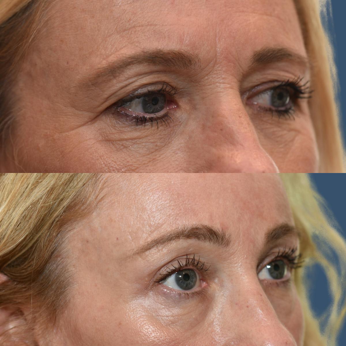 Upper Blepharoplasty Before & After Gallery - Patient 257177 - Image 2