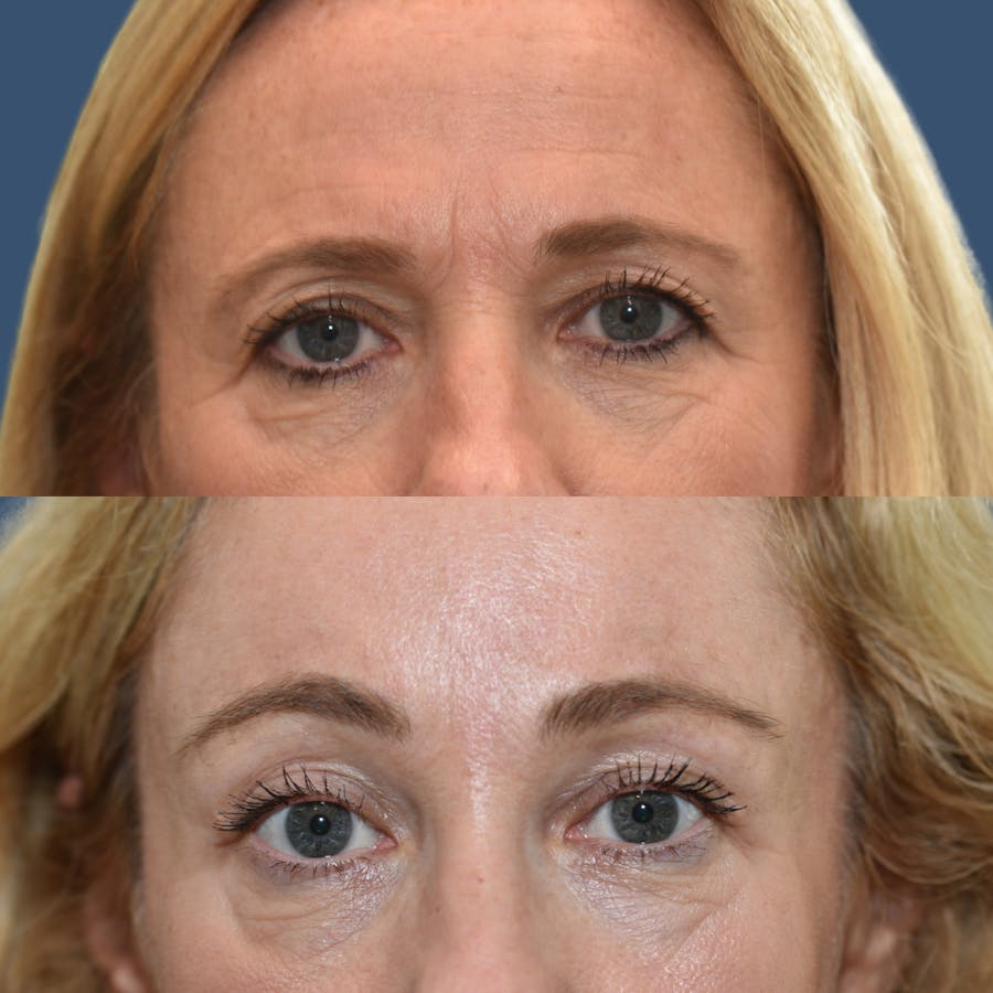 Upper Blepharoplasty Before & After Gallery - Patient 257177 - Image 1