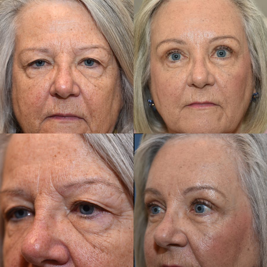 Upper Blepharoplasty Before & After Gallery - Patient 424127 - Image 1