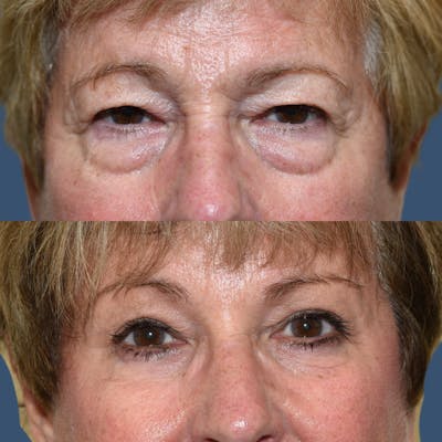 Endoscopic Brow Lift with Upper Blepharoplasty Before & After Gallery - Patient 273418 - Image 1