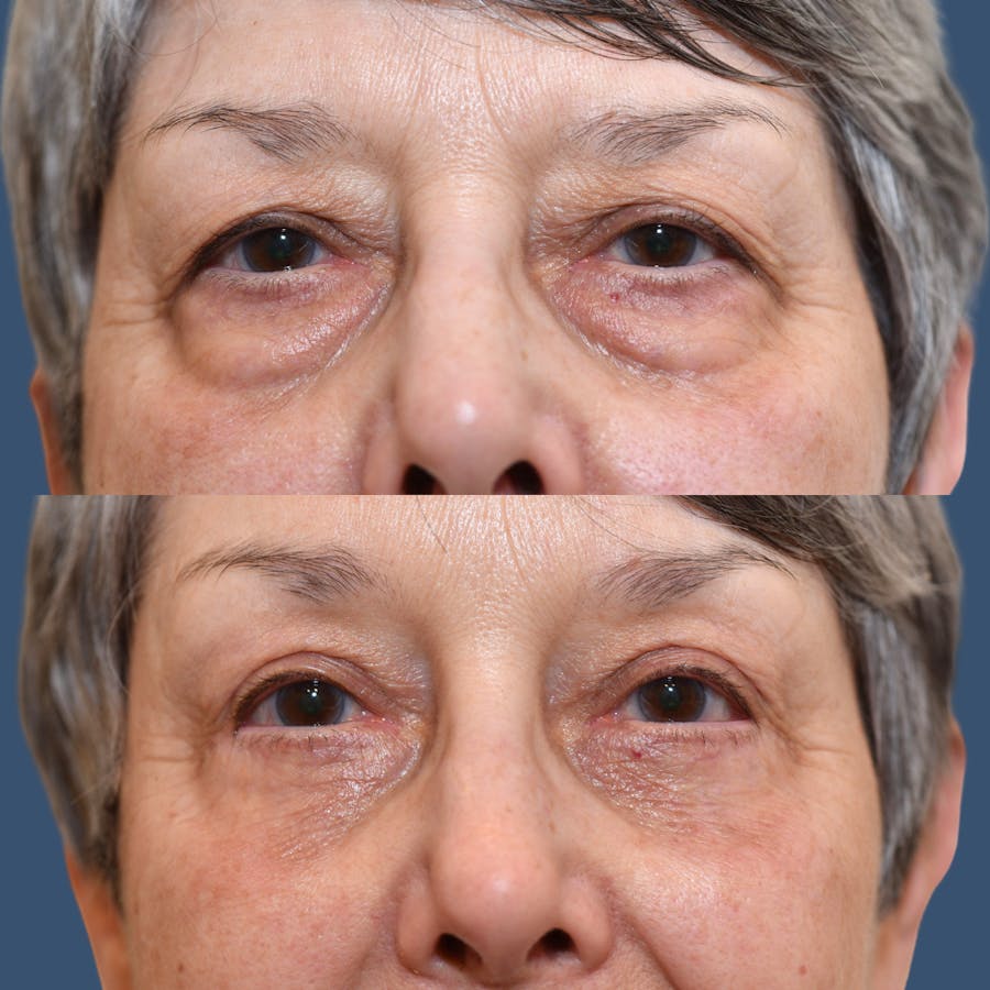 Endoscopic Brow Lift Before & After Gallery - Patient 249332 - Image 1