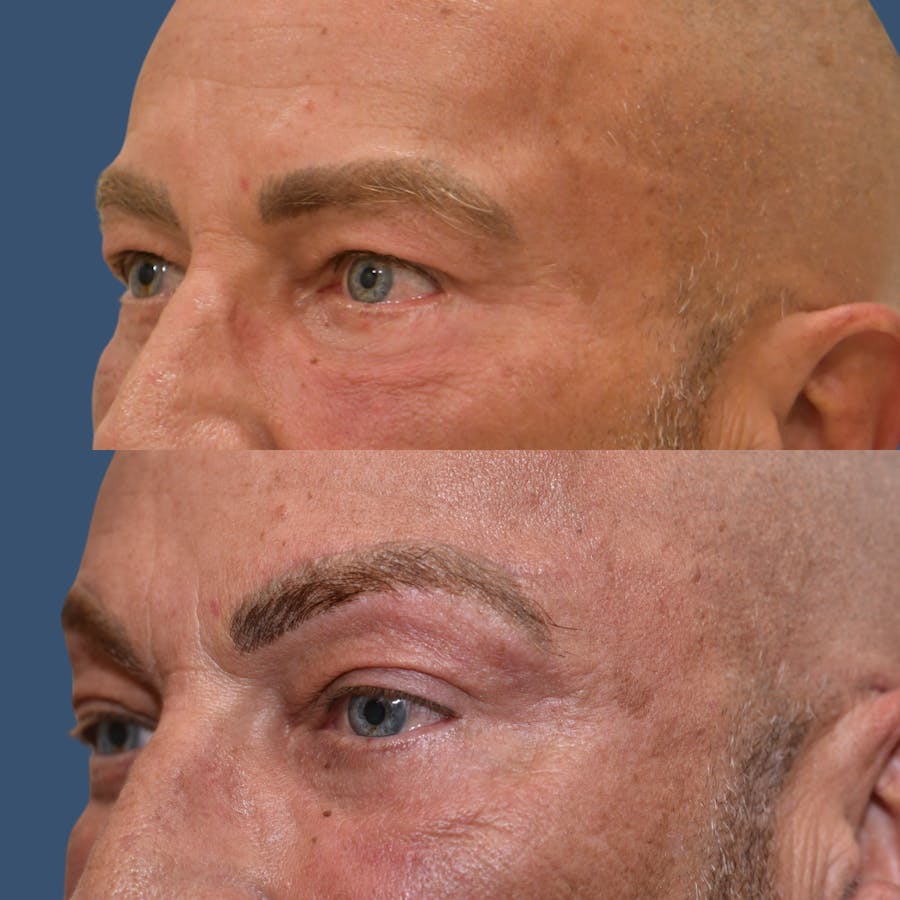 Brow Lift Before & After Gallery - Patient 130124 - Image 1