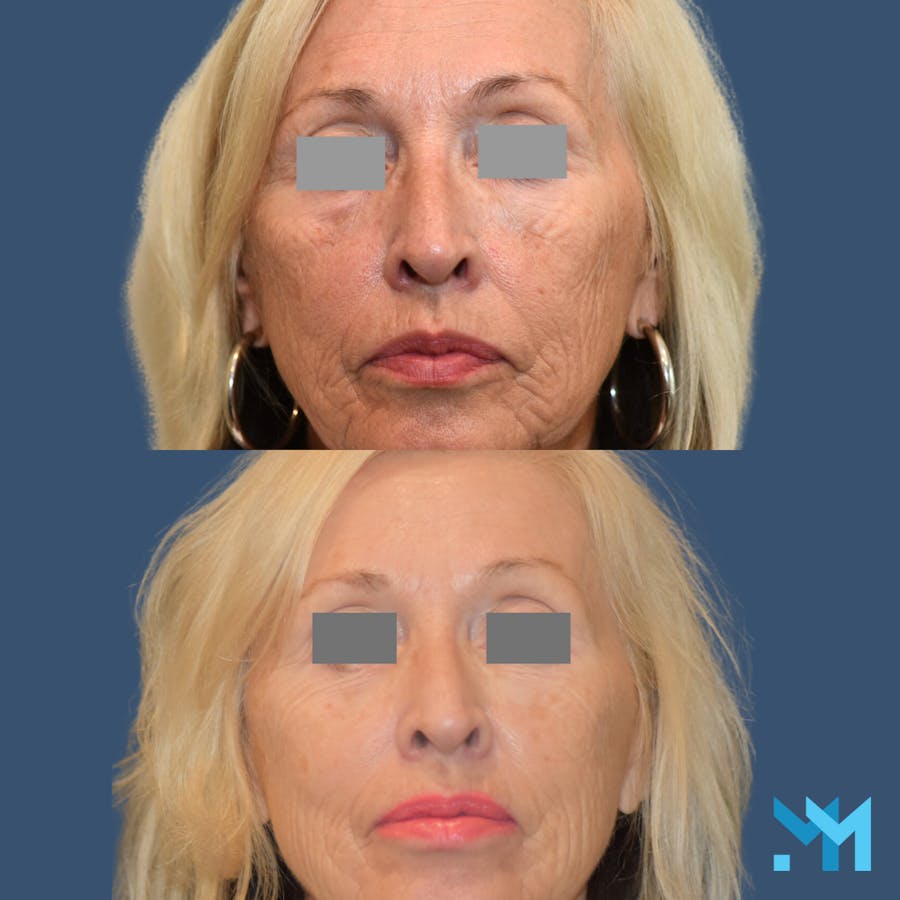 CO2 Laser Resurfacing Before & After Gallery - Patient 400958 - Image 1