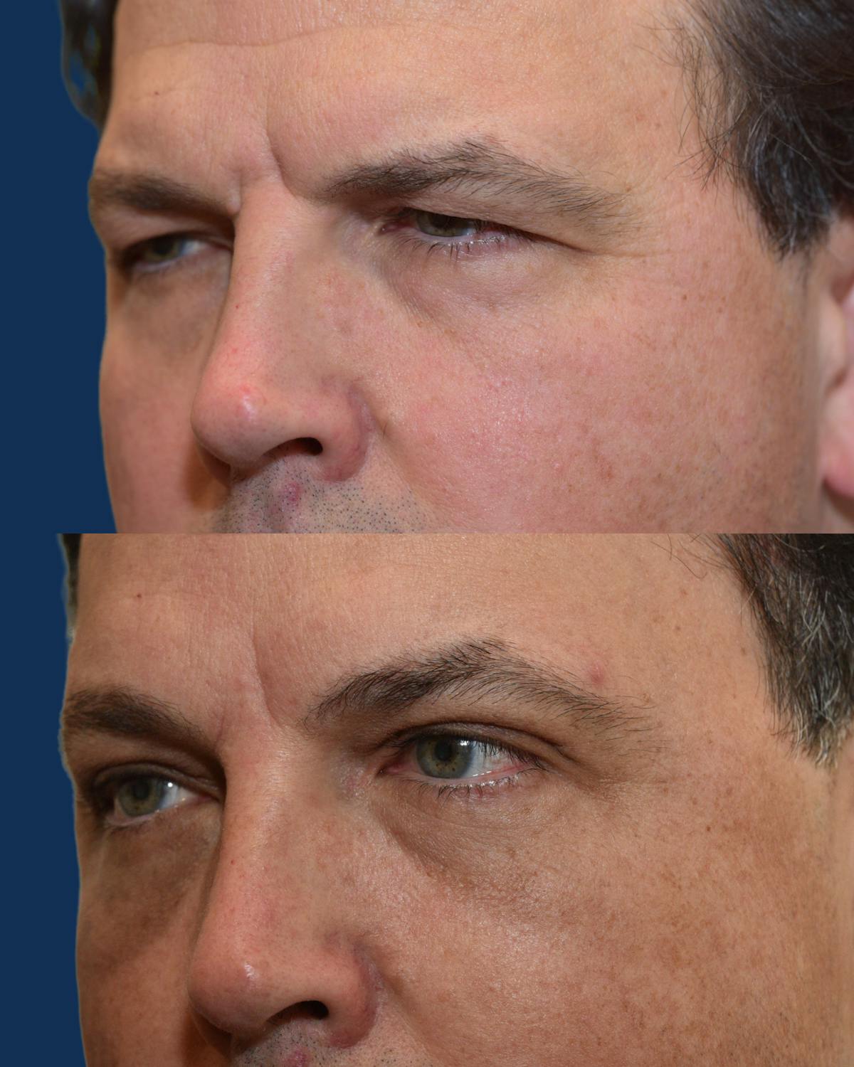 Lower Blepharoplasty Before & After Gallery - Patient 328799 - Image 2