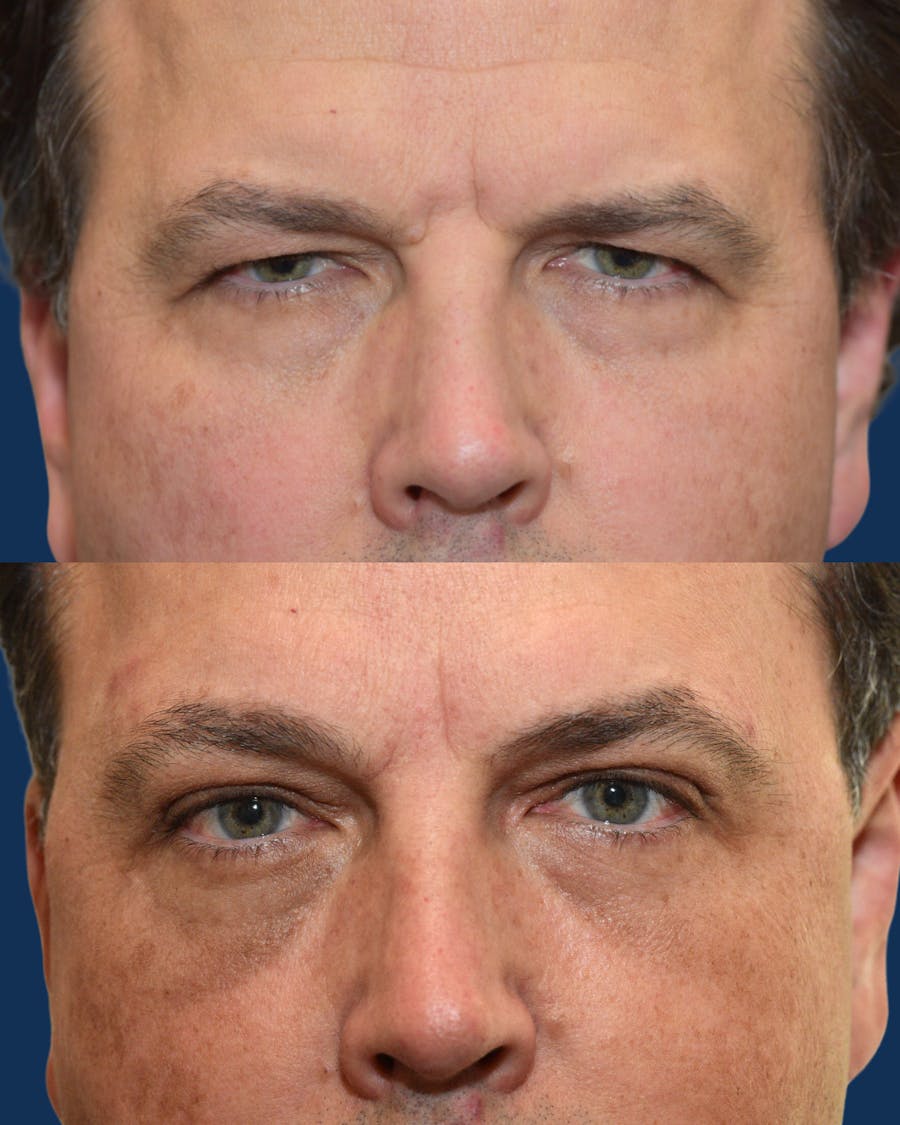 Upper Blepharoplasty Before & After Gallery - Patient 222758 - Image 1