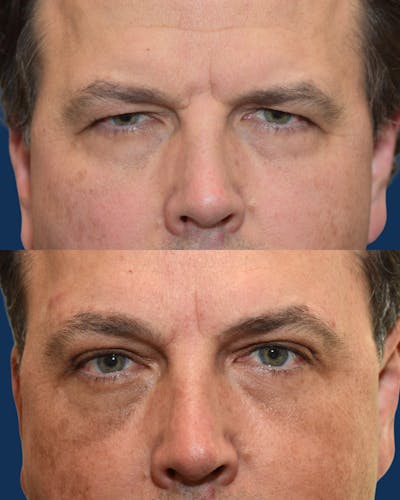 Upper Blepharoplasty Before & After Gallery - Patient 419694 - Image 1