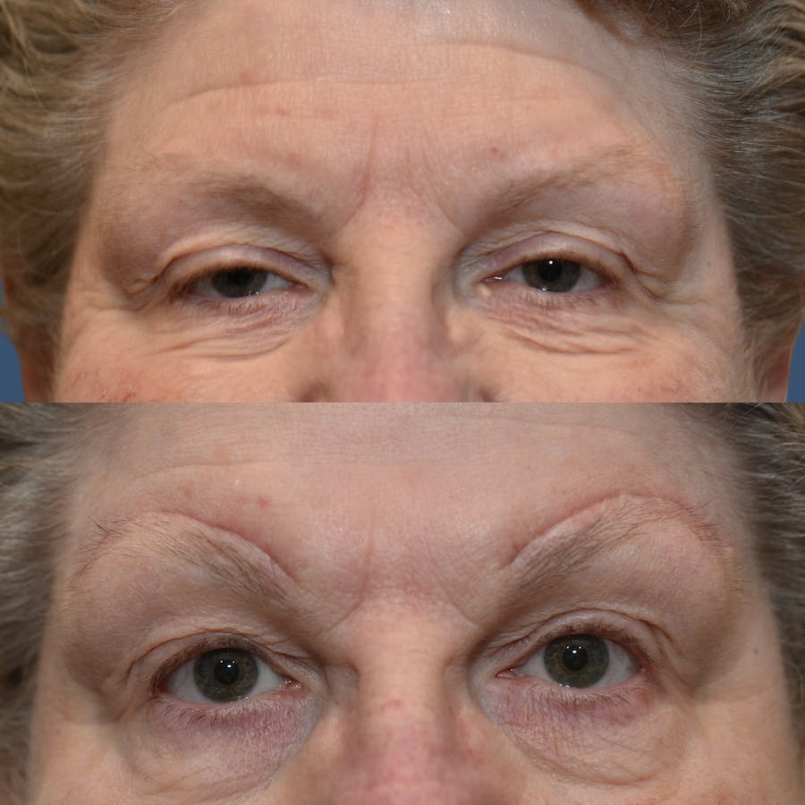 Brow Lift Before & After Gallery - Patient 230115 - Image 1