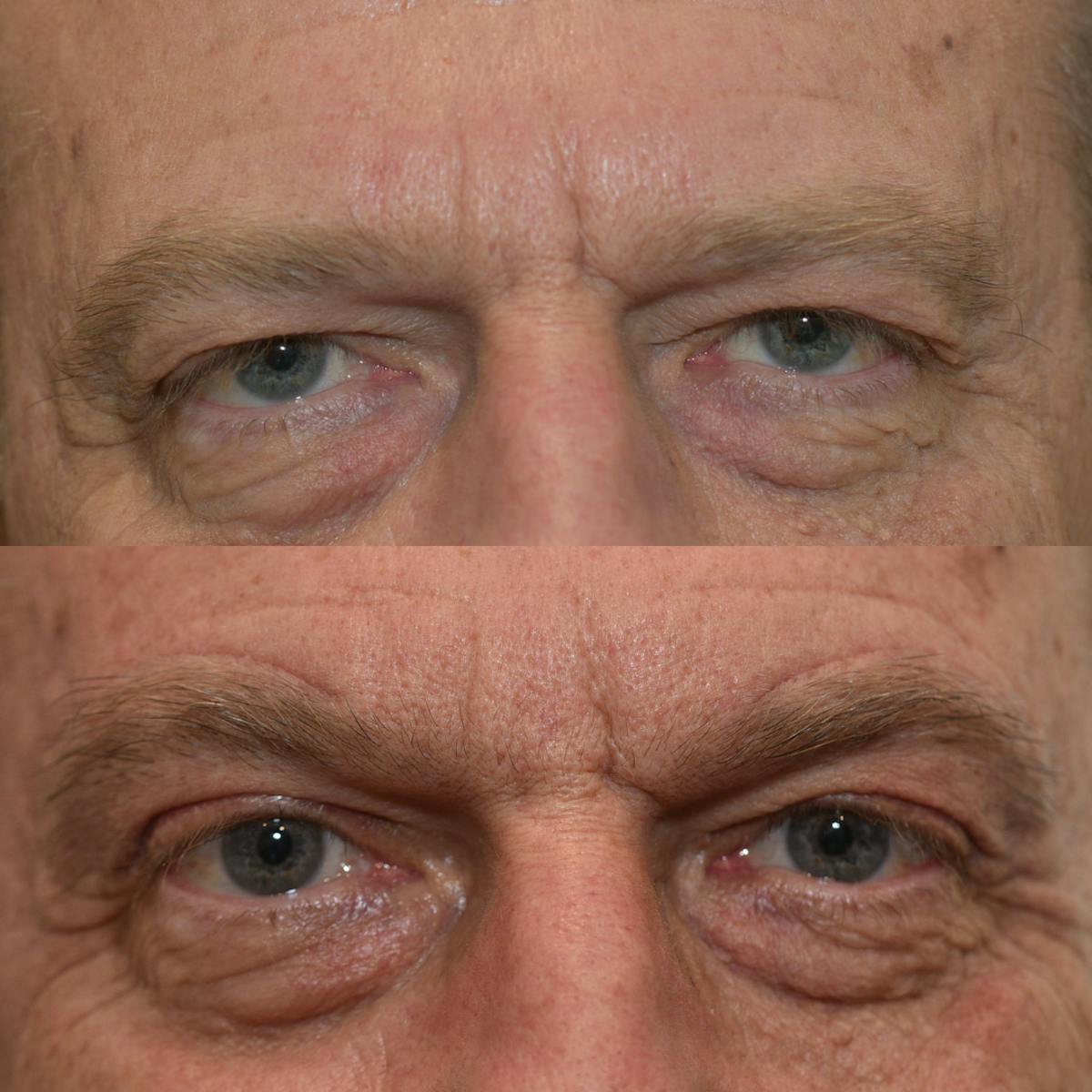 Brow Lift Before & After Gallery - Patient 299323 - Image 1