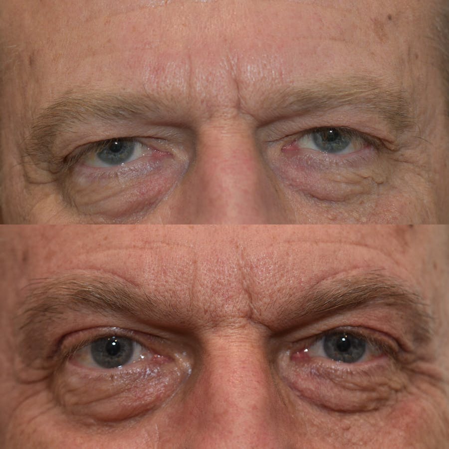 Brow Lift Before & After Gallery - Patient 299323 - Image 1