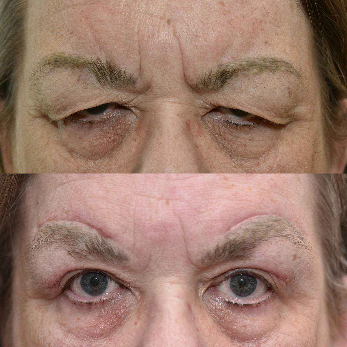 Brow Lift Before & After Gallery - Patient 236677 - Image 1