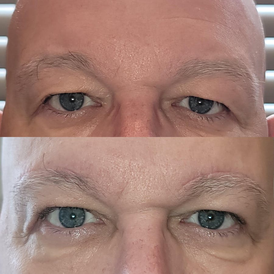 Brow Lift Before & After Gallery - Patient 624117 - Image 1