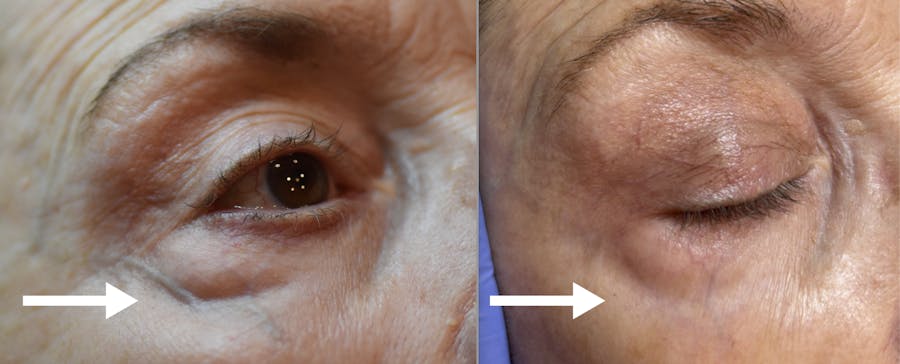Veins + Lesions Before & After Gallery - Patient 380199 - Image 1