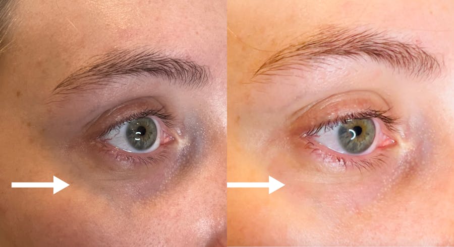 Veins + Lesions Before & After Gallery - Patient 320759 - Image 1