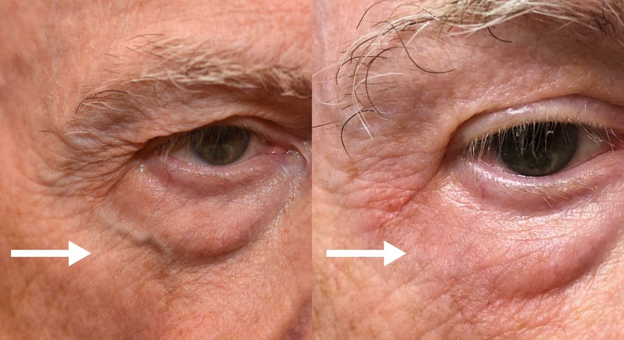 Veins + Lesions Before & After Gallery - Patient 208469 - Image 1