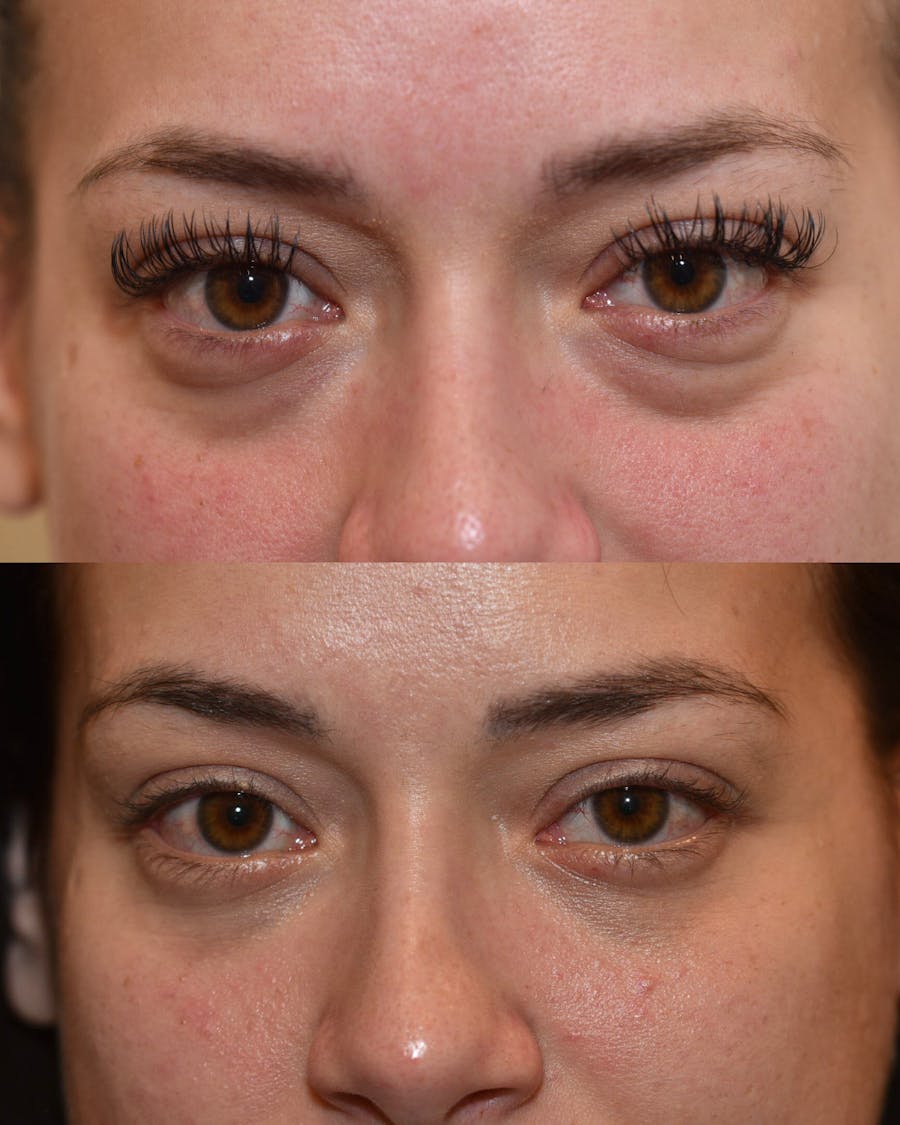 Facial Implants Before & After Gallery - Patient 236033 - Image 1