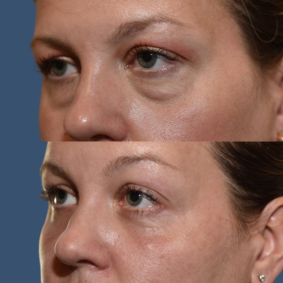 Facial Implants Before & After Gallery - Patient 143682 - Image 1