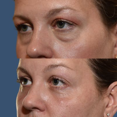 Facial Implants Before & After Gallery - Patient 143682 - Image 1