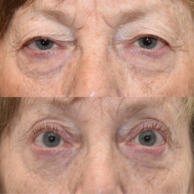 Endoscopic Brow Lift with Upper Blepharoplasty Before & After Gallery - Patient 227026 - Image 1