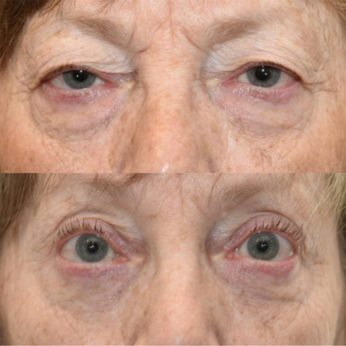 Lower Blepharoplasty Before & After Gallery - Patient 123021 - Image 1