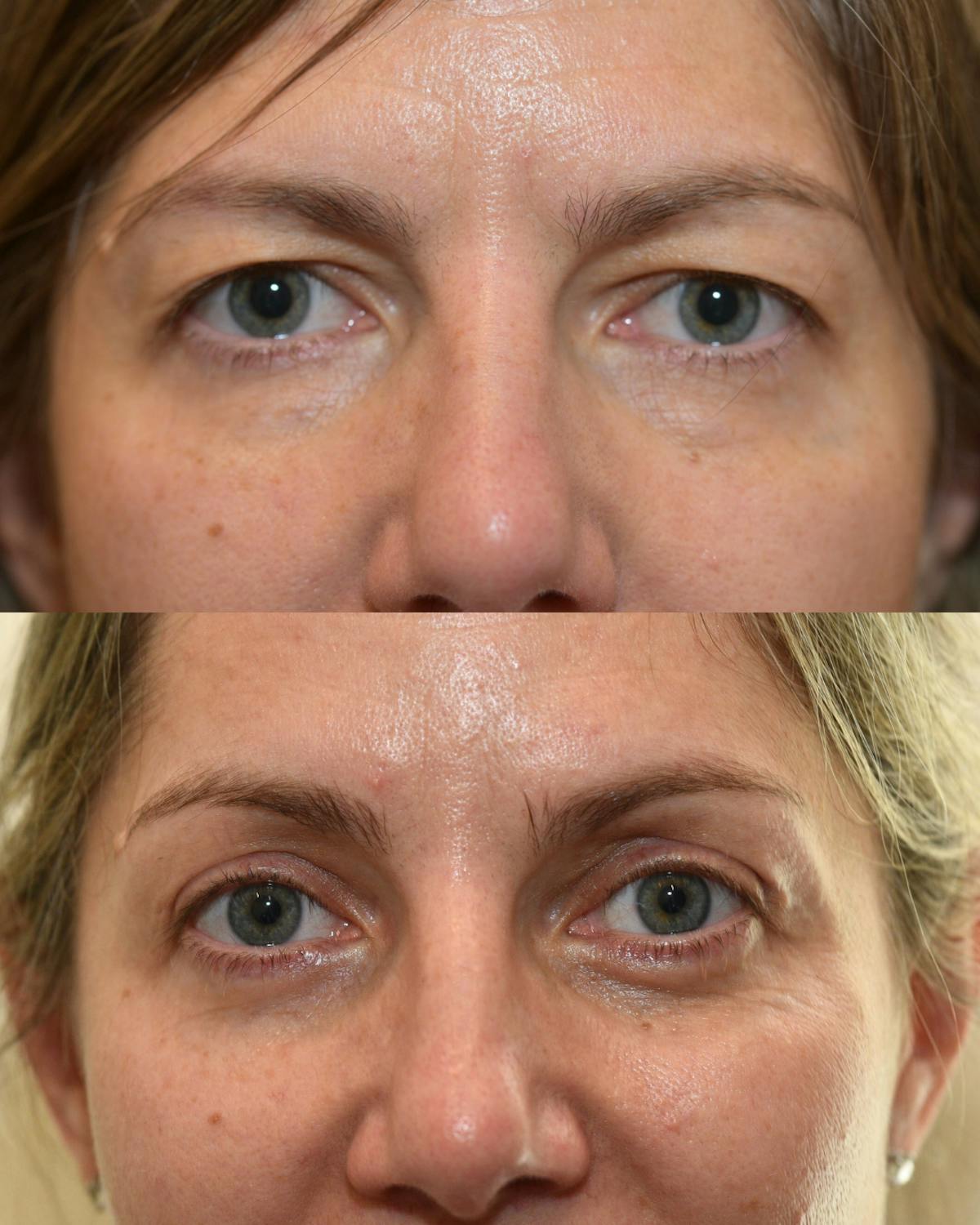 Endoscopic Brow Lift with Upper Blepharoplasty Before & After Gallery - Patient 262352 - Image 1
