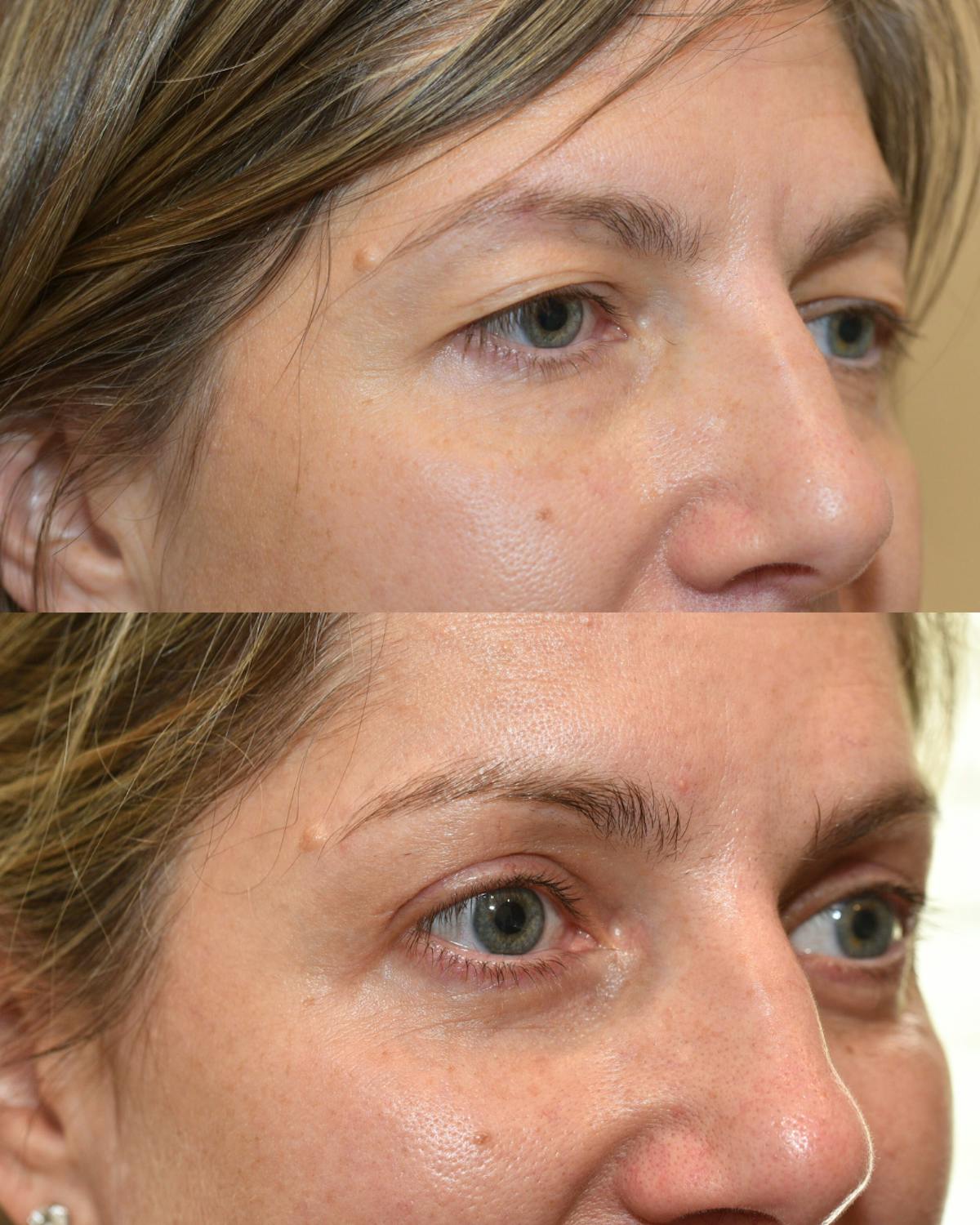 Endoscopic Brow Lift with Upper Blepharoplasty Before & After Gallery - Patient 262352 - Image 2