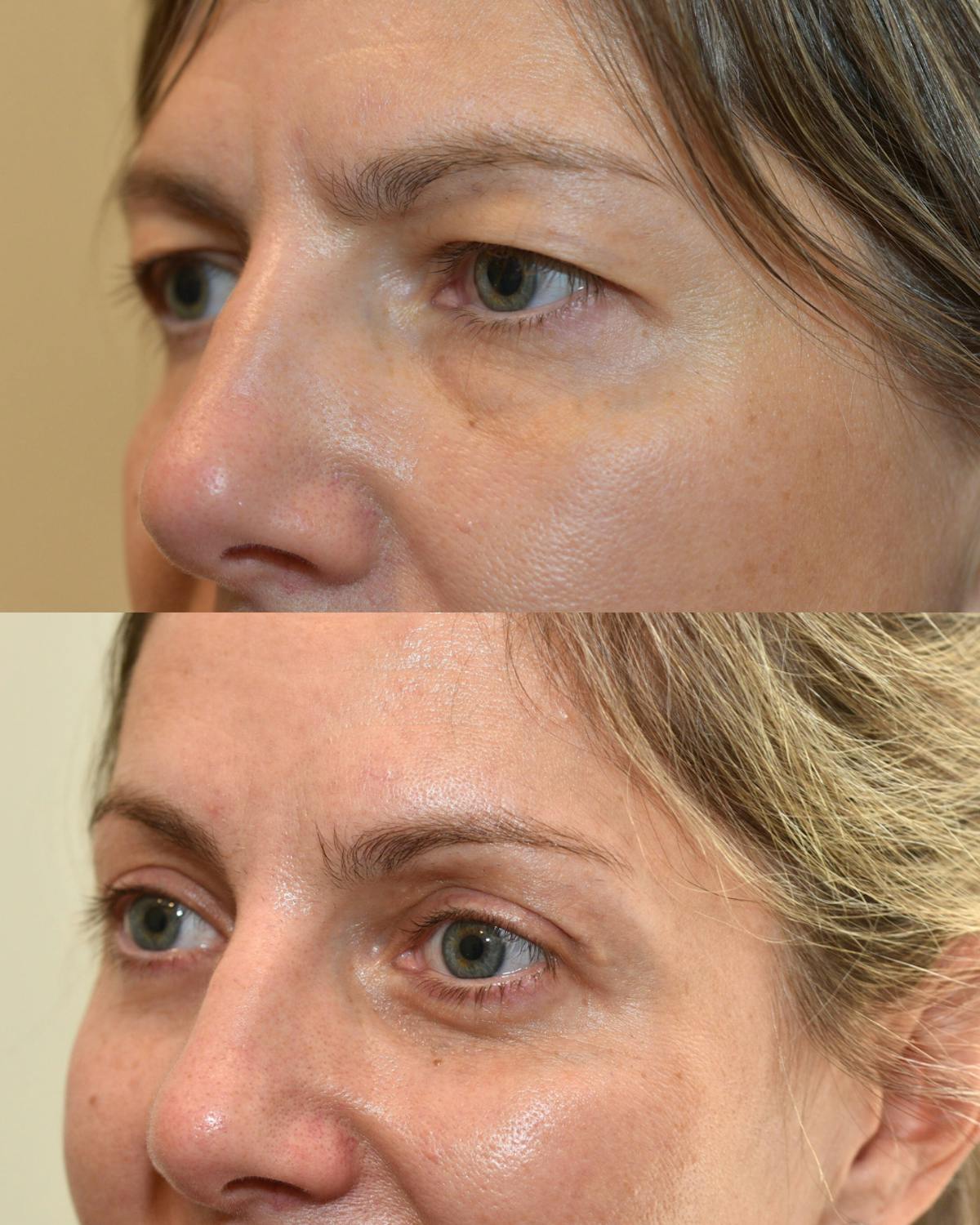 Endoscopic Brow Lift with Upper Blepharoplasty Before & After Gallery - Patient 262352 - Image 3