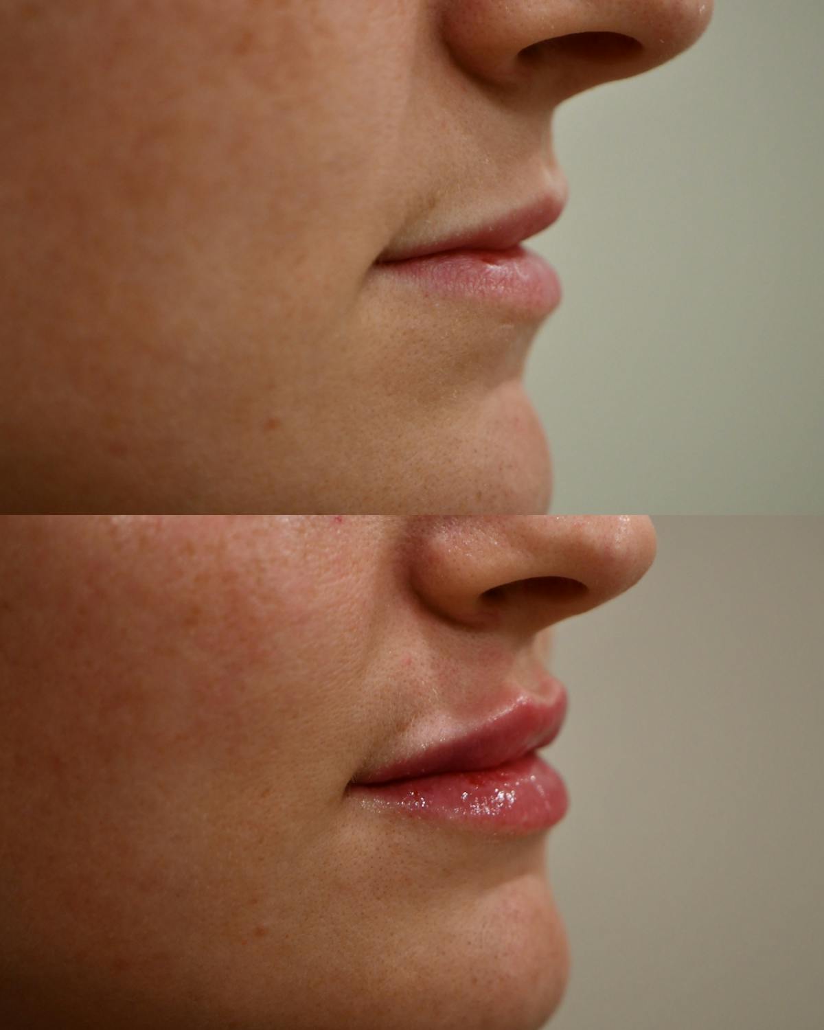 Fillers Before & After Gallery - Patient 285041 - Image 2