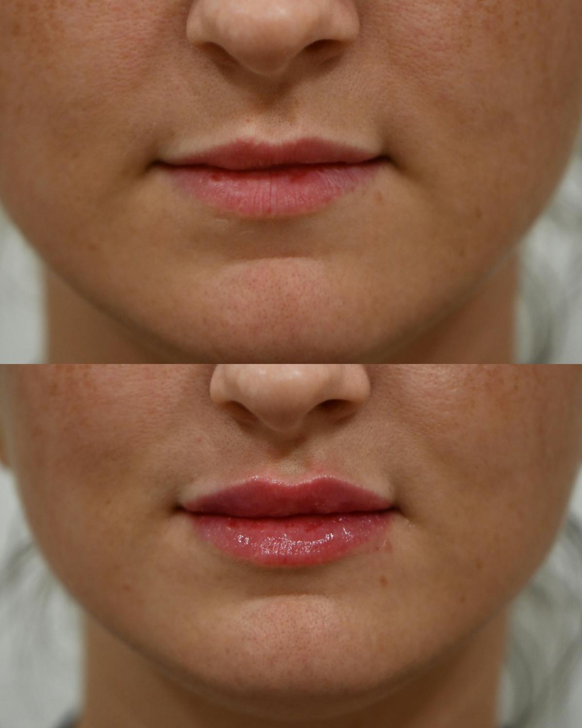 Fillers Before & After Gallery - Patient 285041 - Image 1
