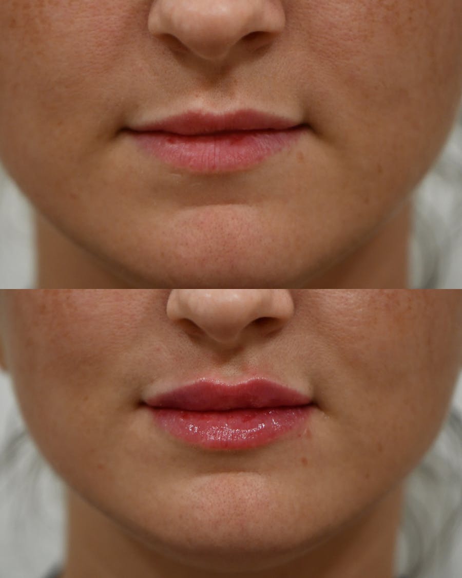 Fillers Before & After Gallery - Patient 285041 - Image 1