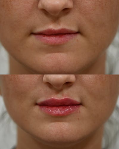 Fillers Before & After Gallery - Patient 285041 - Image 1