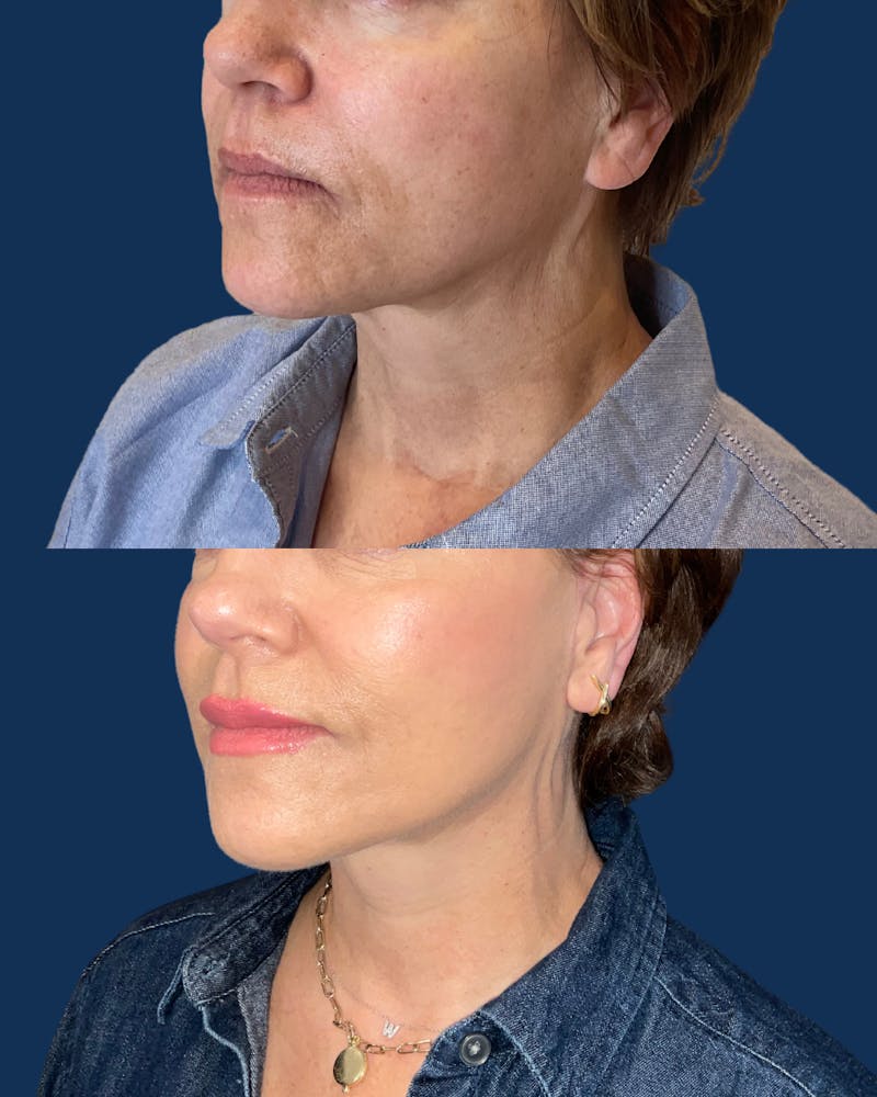 Facelift Before & After Gallery - Patient 101067 - Image 6