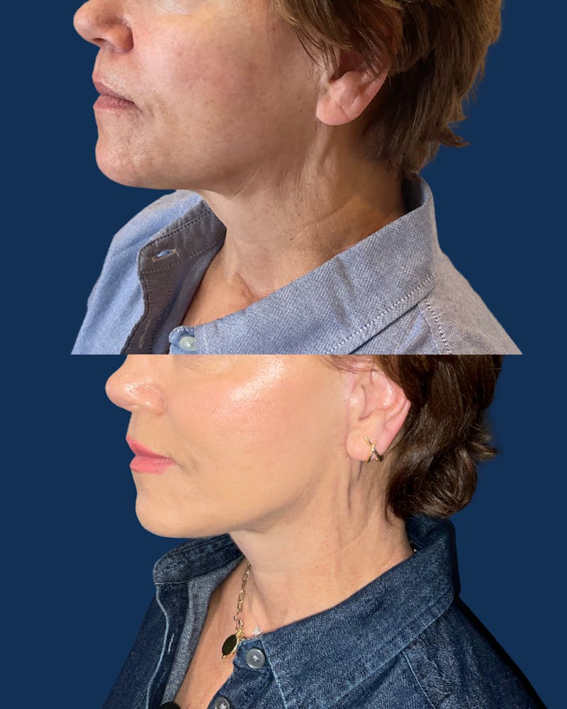 Facelift Before & After Gallery - Patient 101067 - Image 5