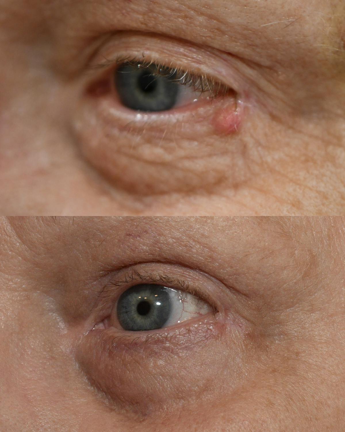 Cosmetic Lesion/Mole Removal Before & After Gallery - Patient 385703 - Image 1