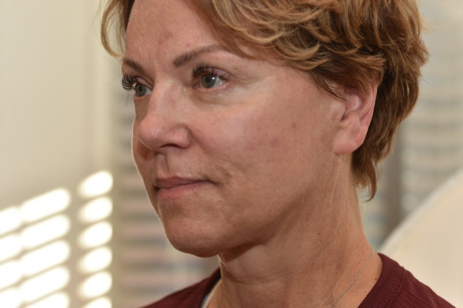 Facelift Before & After Gallery - Patient 101067 - Image 1