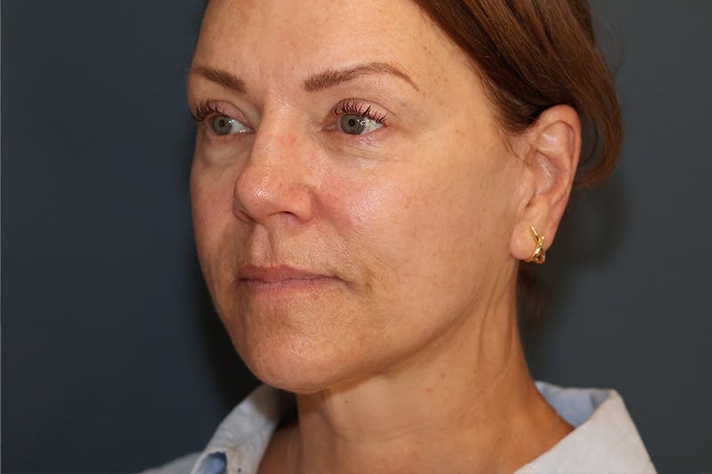 Facelift Before & After Gallery - Patient 101067 - Image 2