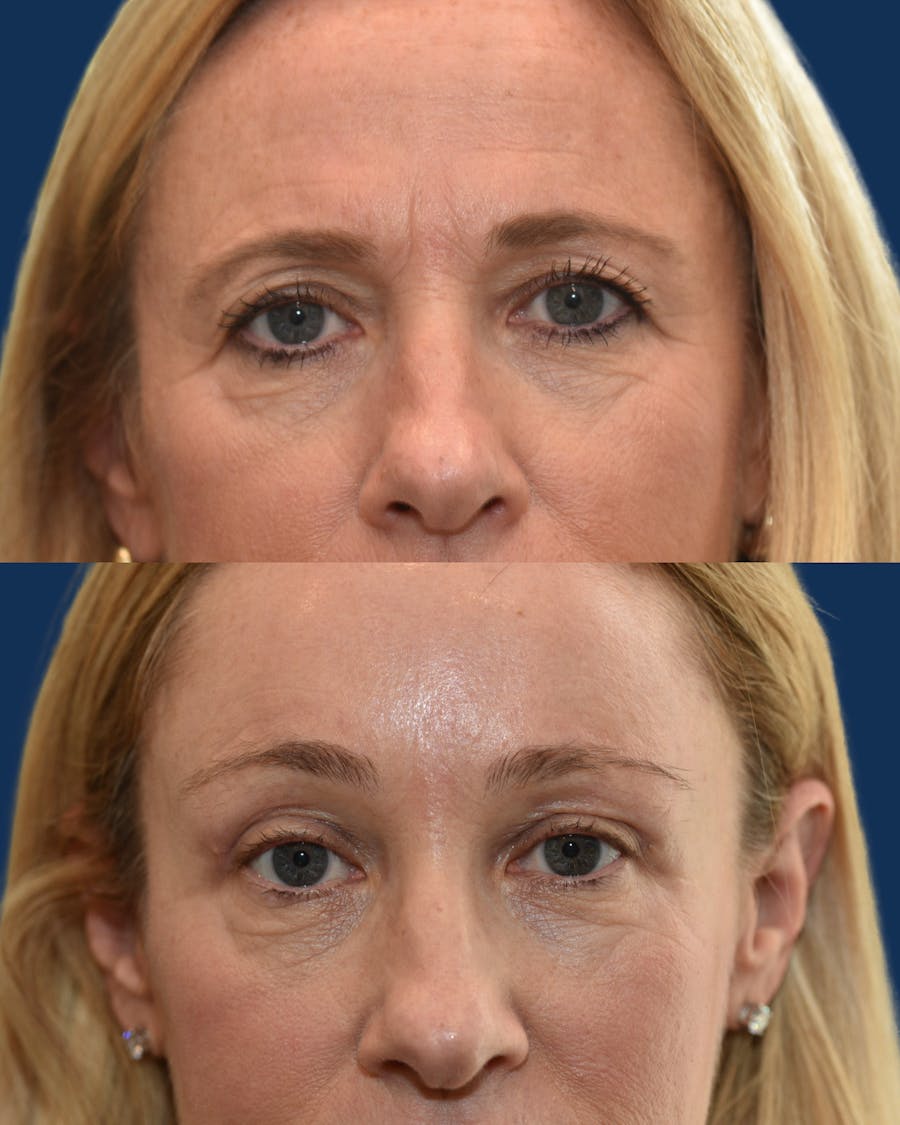 Endoscopic Brow Lift with Upper Blepharoplasty Before & After Gallery - Patient 251954 - Image 1