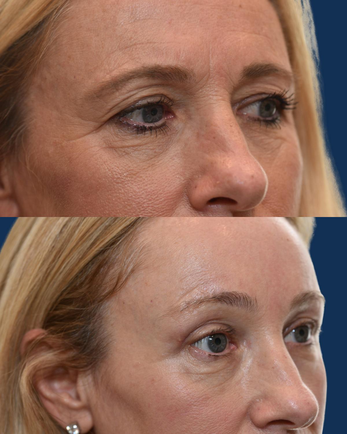 Endoscopic Brow Lift with Upper Blepharoplasty Before & After Gallery - Patient 251954 - Image 2