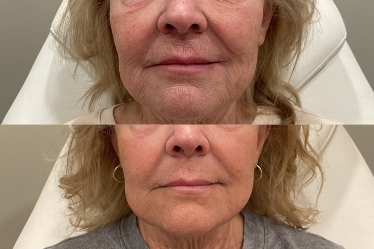 CO2 Laser Resurfacing Before & After Gallery - Patient 235997 - Image 3