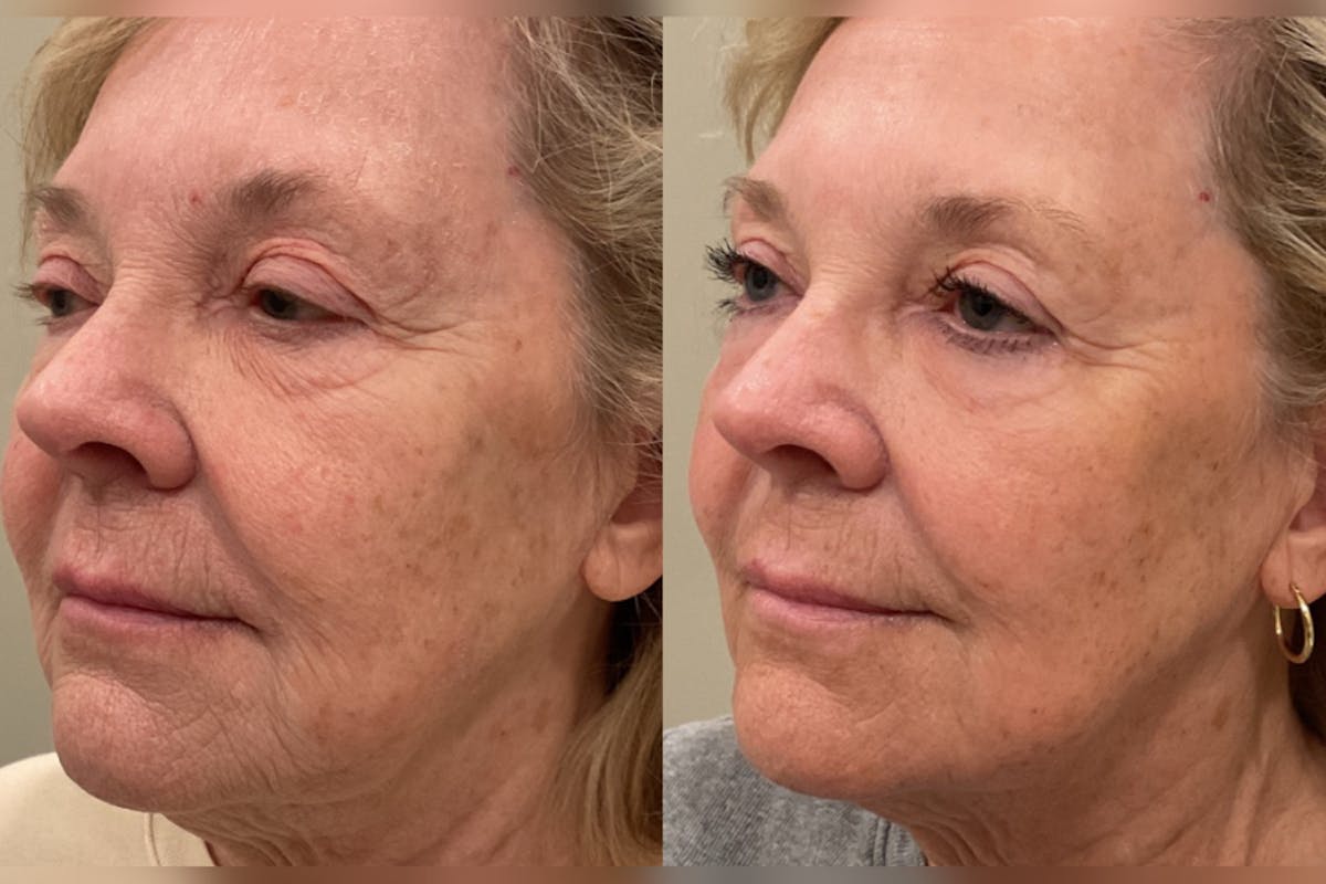 CO2 Laser Resurfacing Before & After Gallery - Patient 235997 - Image 2