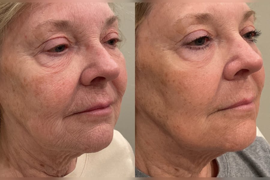 CO2 Laser Resurfacing Before & After Gallery - Patient 235997 - Image 1