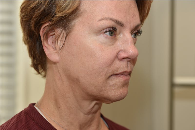 Facelift Before & After Gallery - Patient 101067 - Image 3